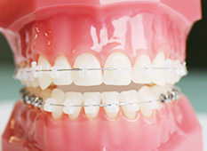 歯列矯正治療