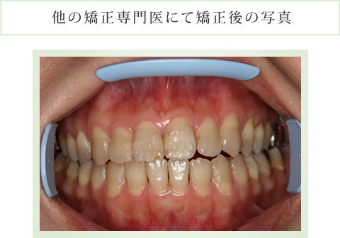 他の矯正専門医にて矯正後の写真